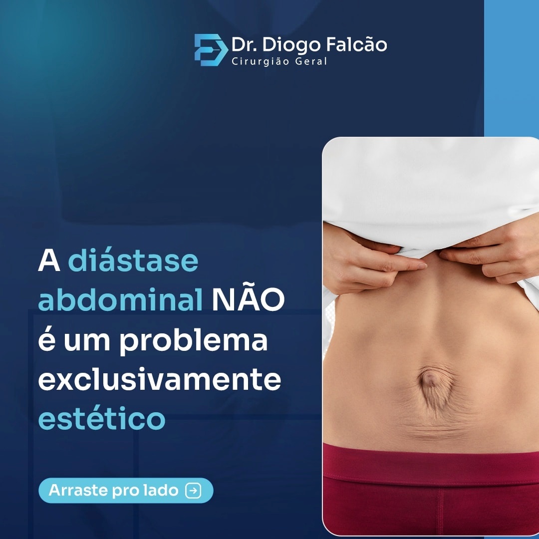 A diástase abdominal não é um problema exclusivamente estético