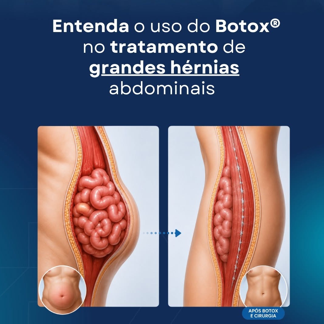 botox ajuda no tratamento de grandes hernias abdominais